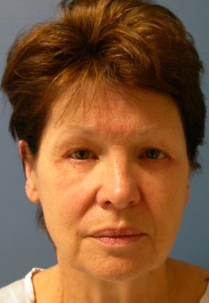 Facelift Before and After Results