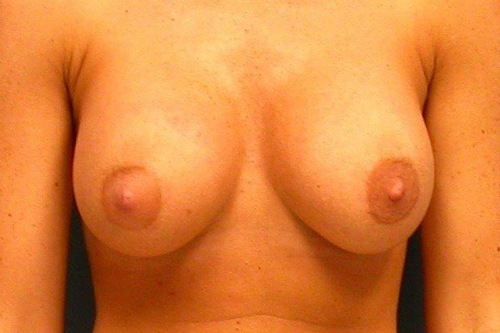 Breast Augmentation Results Dayton