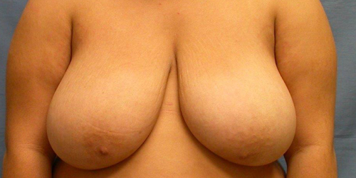 Breast Reduction Before & After Results