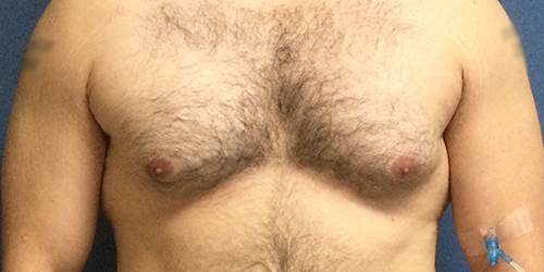 Gynecomastia Before & After Results