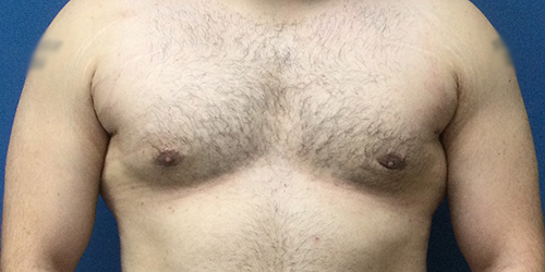 Gynecomastia Before & After Results