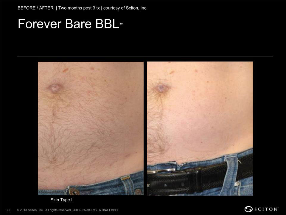 bbl before and after